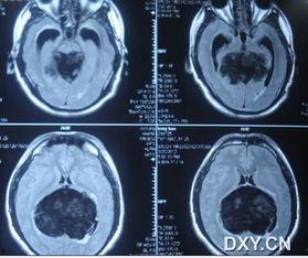 肿瘤照片,揭示癌症的视觉秘密