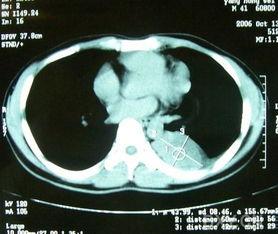 肿瘤照片,揭示癌症的视觉秘密